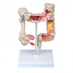 หุ่นจำลองลำไส้ใหญ่